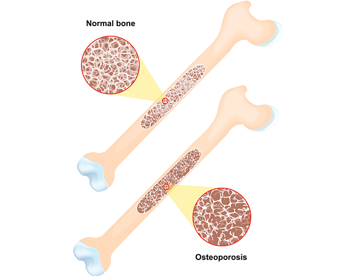 Bone Loss and Cancer